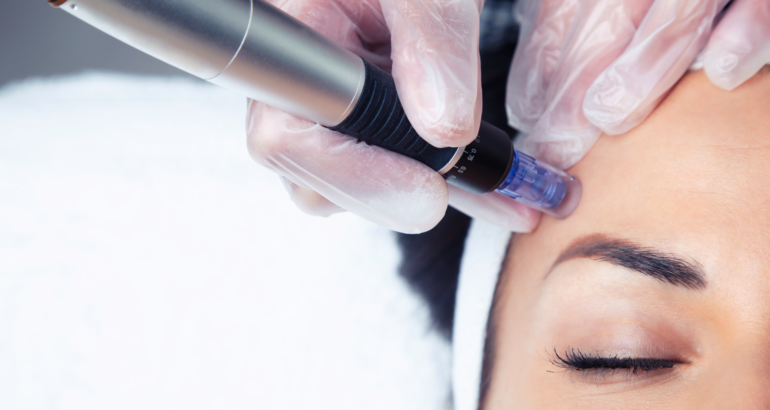 PRX-T33 & Microneedling – Skin Regeneration for Face & Neck